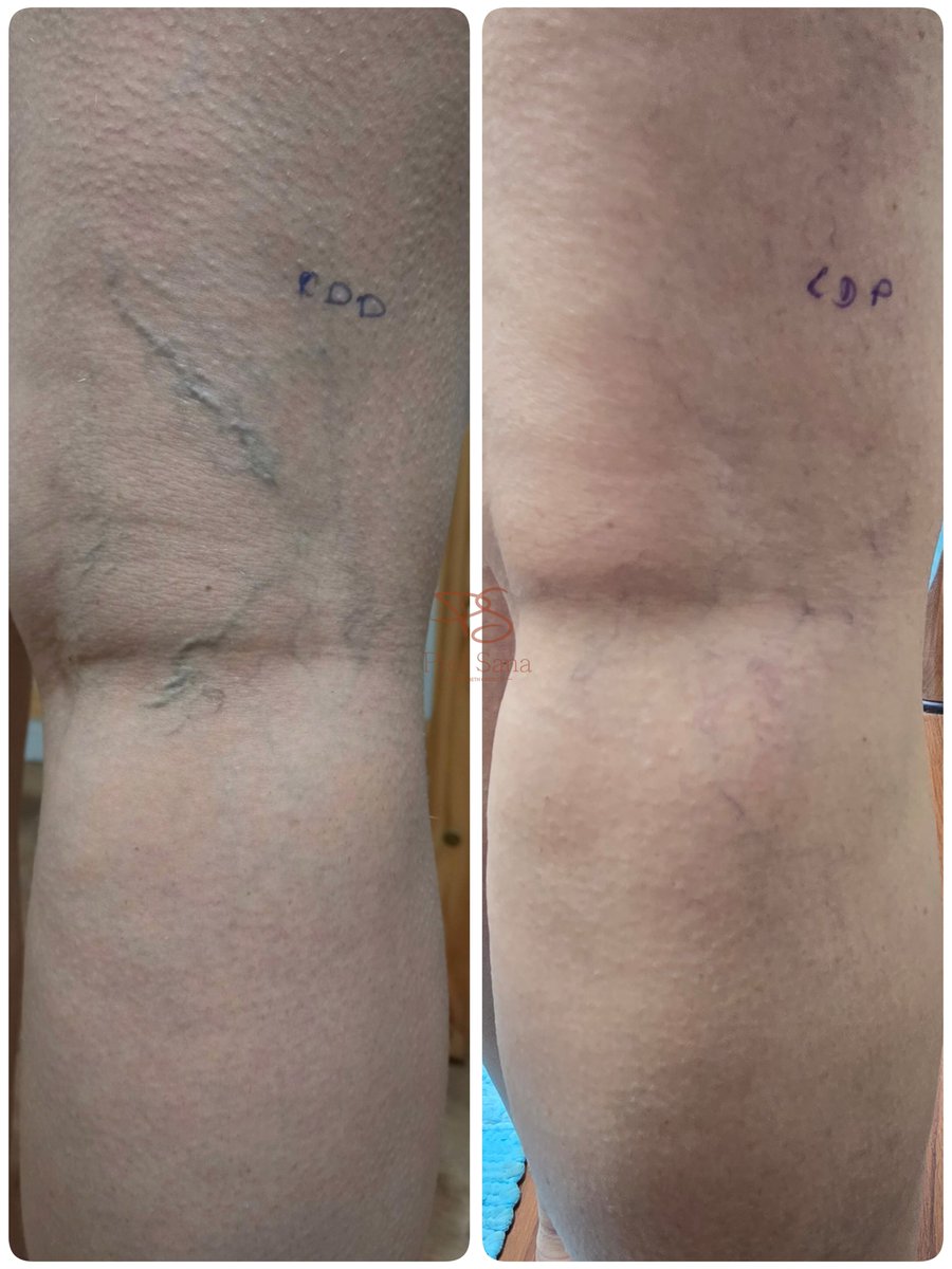 pielsanauy's tweet photo. La escleroterapia no solo busca mejorar el aspecto de las piernas.

Cuando el tratamiento está bien indicado, correctamente realizado y el paciente se compromete con el proceso, los resultados pueden mantenerse incluso frente a etapas de grandes cambios, como un embarazo. https://t.co/1n4kTrY6Mg