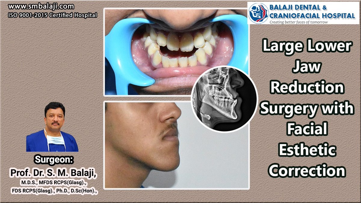 balajidental's tweet photo. Large Lower Jaw Reduction Surgery with Facial Esthetic Correction
#LowerJawReduction #MandibularPrognathism #JawSetbackSurgery https://t.co/qqyEbDAfAP
