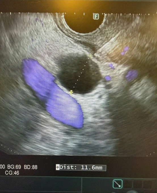 Endoscopic ultrasound image showing a 11.6mm measurement with highlighted areas in purple.