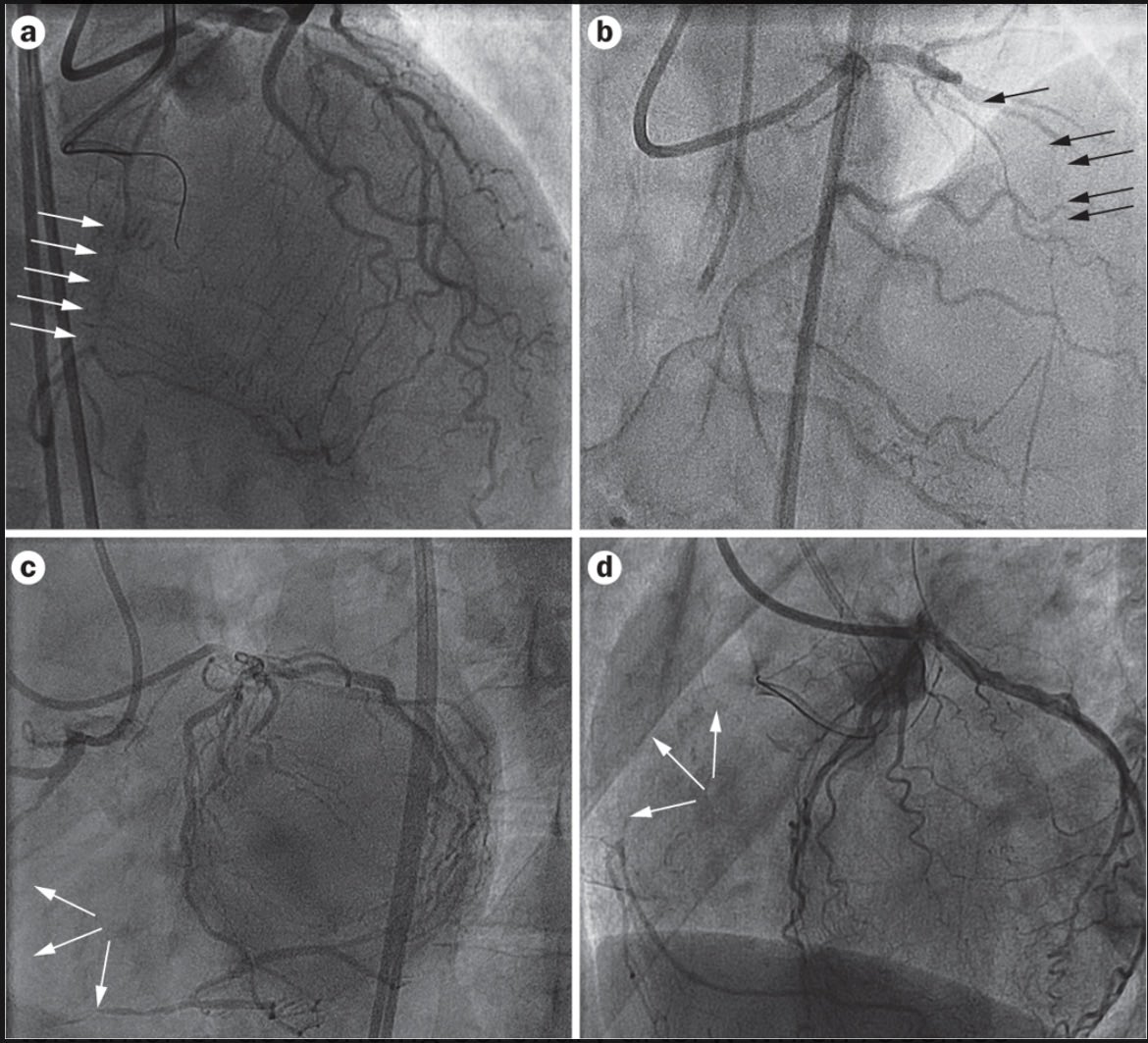eodanielmd's tweet photo. Spotting a CTO on cath🫀
🔴 Blunt/tapered proximal cap, no lumen (TIMI 0)
🔴 No fresh thrombus or contrast staining
🔴 Calcification along the occluded segment
🔴 Well-developed, mature collaterals filling the distal vessel
🔴 Hard, resistant cap on wiring
#cardiorounds https://t.co/GIyGgAcUow