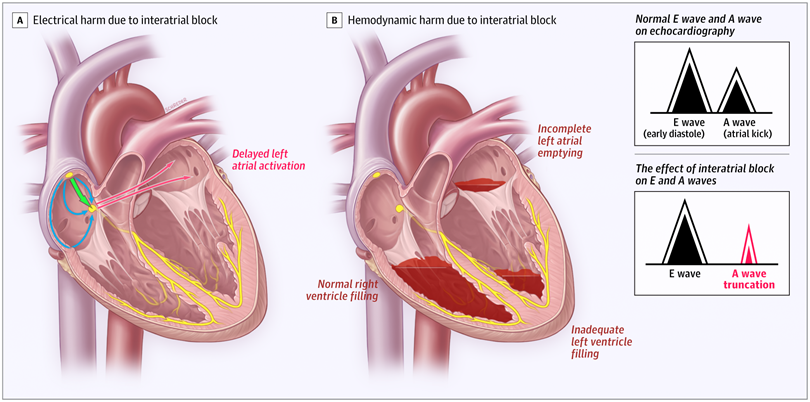 gbiondizoccai's tweet photo. Must-read review on atrial dyssynchrony and Bachmann bundle pacing in the latest issue of JAMA Cardiology https://t.co/SXU4c5au6i @JAMACardio https://t.co/XG8DHmesR5