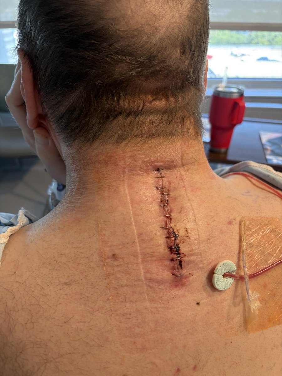 Woodsman602's tweet photo. Another surgery on my spine Monday. 
If this and $6 diesel doesn’t keep my from going to the @SDCoyotesFB game on Saturday what’s your excuse? 
#DefendTheDome https://t.co/c0dmr2ICCg