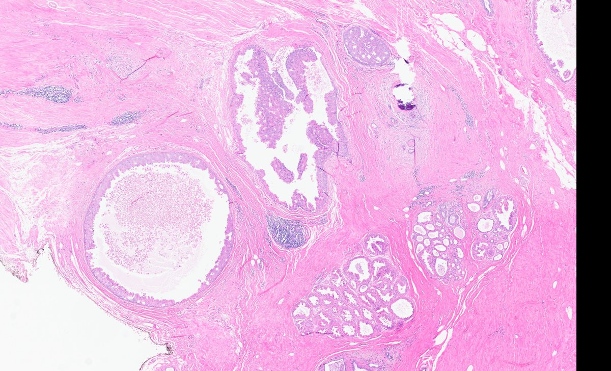 fouad_boulos's tweet photo. Citizens of X! Long time no see. #breastpath has been particularly quiet as of late. 

Here's a little something to liven it up a bit.

I think this is the first time I see apocrine DCIS growing in a pagetoid pattern under apocrine metaplasia, which I believe is a pretty strong hint that this is apocrine metaplasia no more.

Have a great weekend!

#PathX #PathTwitter