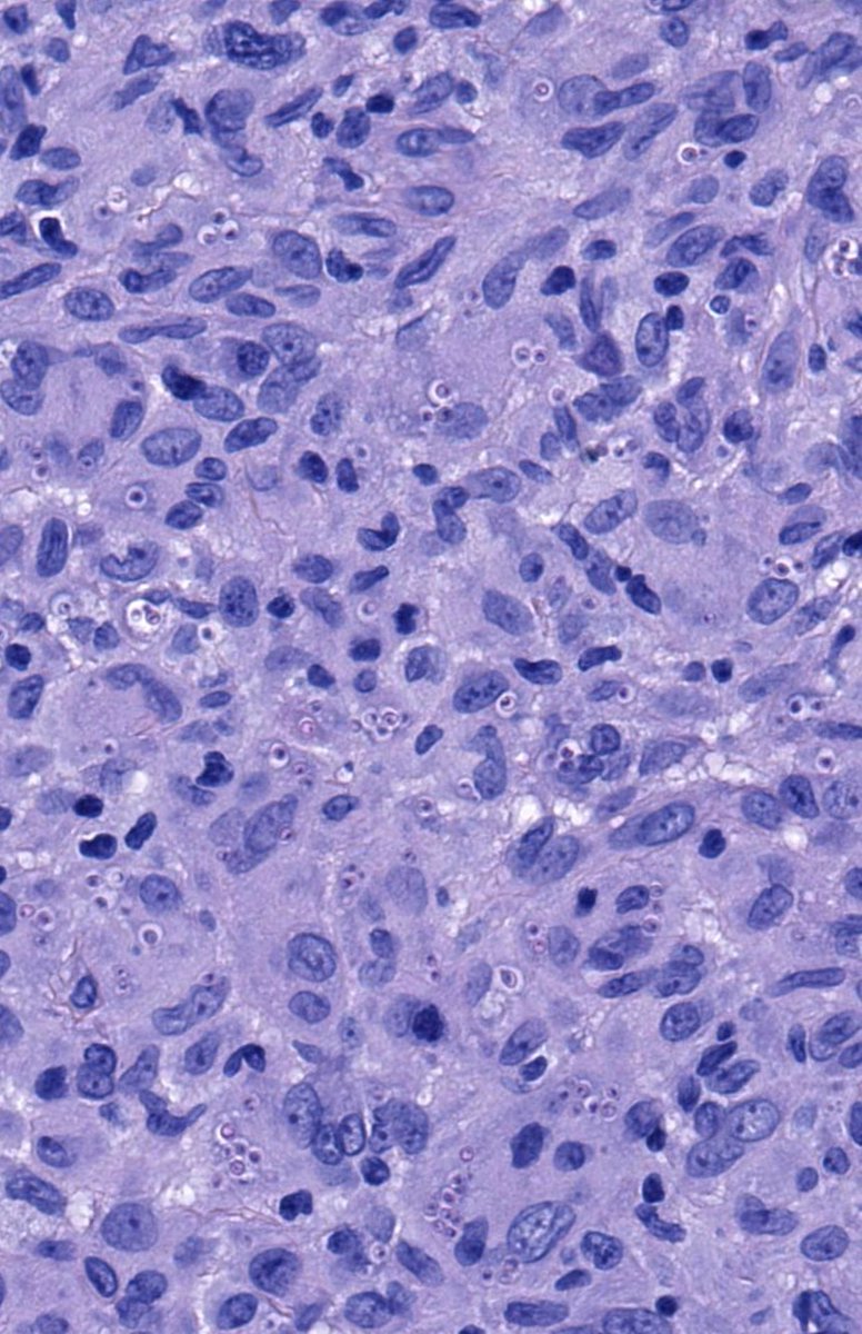 JMGardnerMD's tweet photo. 30 M. Multiple skin papules. Diagnosis?
Digital slide🔬 https://t.co/q1pqW0Fu7f
Answer ✅ https://t.co/APAC6w6bQj
Similar cases: https://t.co/CVHjld7akf & https://t.co/H9brWomauq
#pathology #pathTwitter #dermpath #dermatology #dermatologia #dermtwitter https://t.co/8T2d7i12ZC