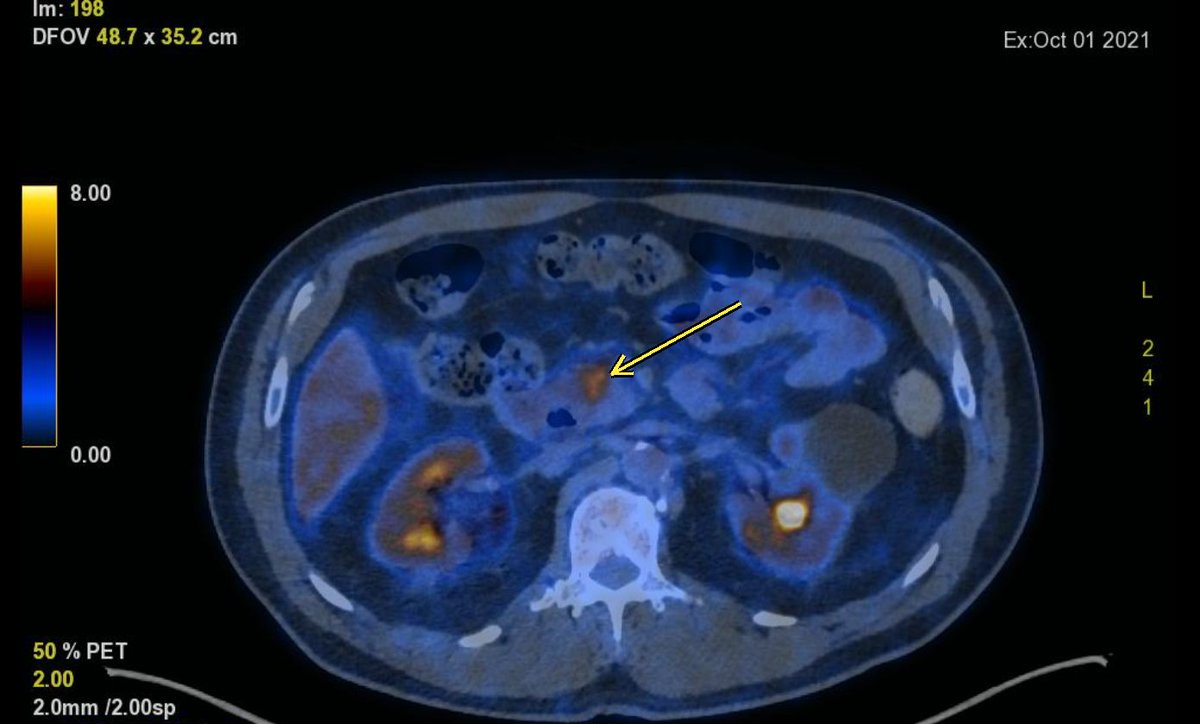 YannickBuccella's tweet photo. Five years ago I met a patient with stage 4 pancreatic cancer, the diagnosis most people fear most. Today there is no evidence of disease. 

This isn't luck, and it isn't a miracle cure. It's precision medicine working exactly as designed.
Their tumor carried a BRCA mutation, a flaw in the cancer's ability to repair its own DNA. Six months of chemo, then three years of olaparib, a drug that targets that exact weakness. The cancer couldn't fix the damage.

Not every pancreatic cancer has this vulnerability, only roughly 10% do. But this is why we test. Why we sequence tumors. Why science can change everything.
Stage 4 pancreatic cancer, five years, no evidence of disease. I don't get to write that sentence often. Today I do.