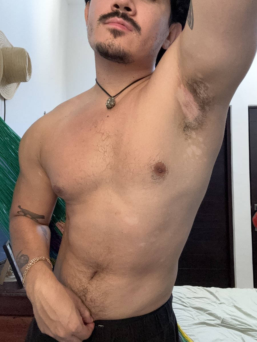 _Enriquevazquez's tweet photo. El vitiligo nos alcanzó https://t.co/6TnyeRozyG