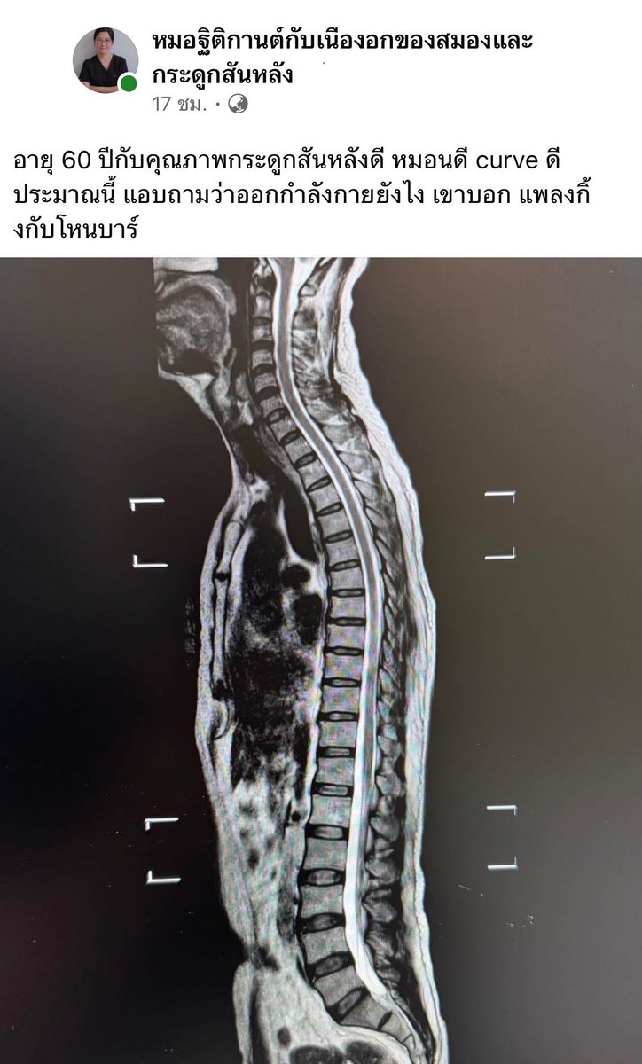 im_sernz's tweet photo. นี่ดูฟิล์ม X-ray ไม่เป็นนะ 

คุณหมอท่านนี้แชร์ข้อมูลบอกว่า 
คนไข้อายุ 60 ปี หมอนดี curve ดี 

หมอเลยแอบถามว่าออกกำลังกายแบบไหน
สรุปออกกำลังกายท่า แพลงกิ้ง กับ โหนบาร์

เคคคคคค เดี๋ยวเจอเลย ทำทุกวัน5555

เหมือนมีคนเคยออกมาบอกว่าการโหนบาร์จะช่วยให้กระดูกสันหลังเรามันคลายและตรงขึ้นไหมนะ? น่าสนใจ