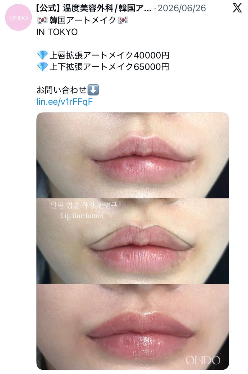 gokigen_chiwawa's tweet photo. 今回の1泊2日の渡韓スケジュール

初日
🏥全顔、うなじ脱毛
🏥ララピール
🏥リジュランヒーラー、水光注射
🏥リップアート(上唇のみ拡張アート)
🛍️クロムハーツ
🍽️ スケジュル清潭
💭ベルリオ清潭　シーシャ
深夜　カジノ

人中短縮してから唇の形が🗻だから外側ずっと気になってるの😭😭😭😭 https://t.co/cvLVLJMDNR