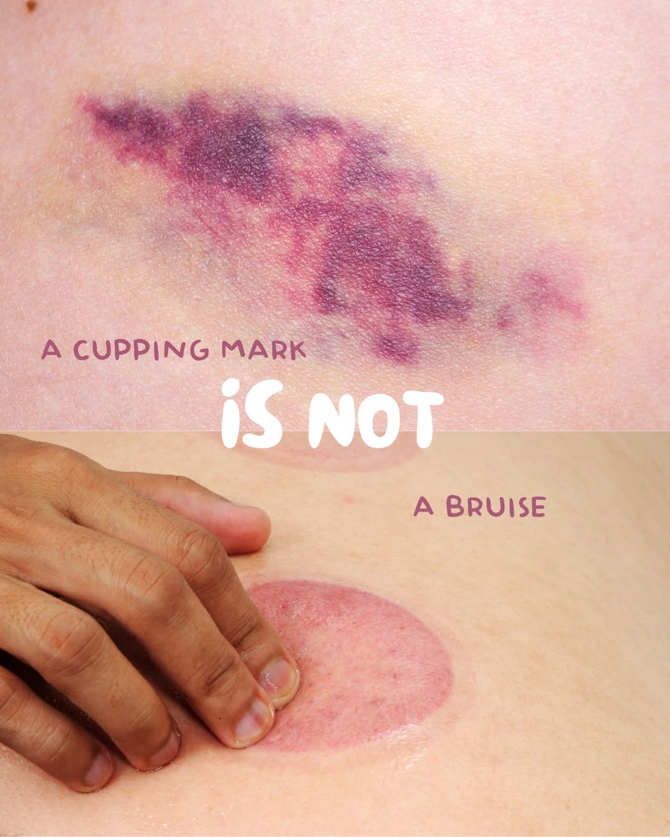 diegoreis177's tweet photo. Let’s clear something up. A cupping mark is not a bruise.

A bruise happens when the skin is injured and small blood vessels break, trapping blood under the skin. It’s usually sore to the touch.

A cupping mark is different. It’s simply the result of... https://t.co/Jt5n49YBTo