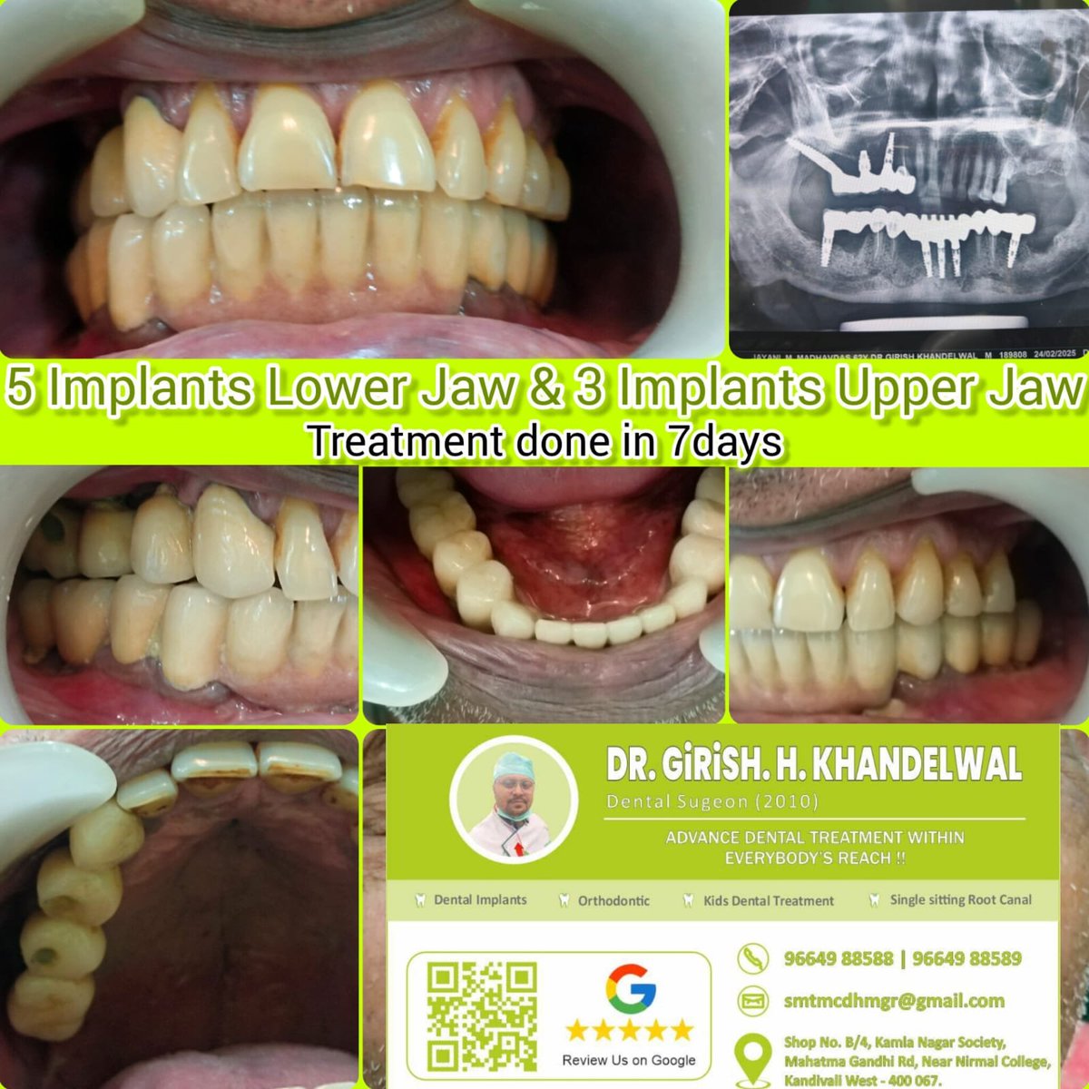 SMTDCC2010's tweet photo. 🦷🇺🇸 USA se aaye patient ke paas India visit ke liye sirf 7 days ka time tha. Yeh ek challenging Full Mouth Implant Case tha, jise Dr. Girish H. Khandelwal ne proper Planning, Experience aur Advanced Dental Techniques ke saath sirf 3 days mein complete kiya। ✨

Total 8 Dental Im https://t.co/89ORz3zLjx