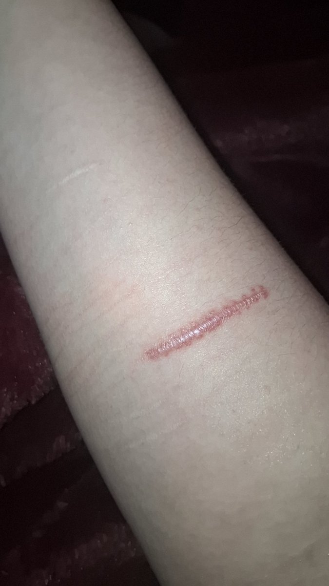 angelwingssbfy's tweet photo. @garbagejerky pic of the scar after the stitches fell out  I fukin hateee the scar https://t.co/MR9xKuQxEO