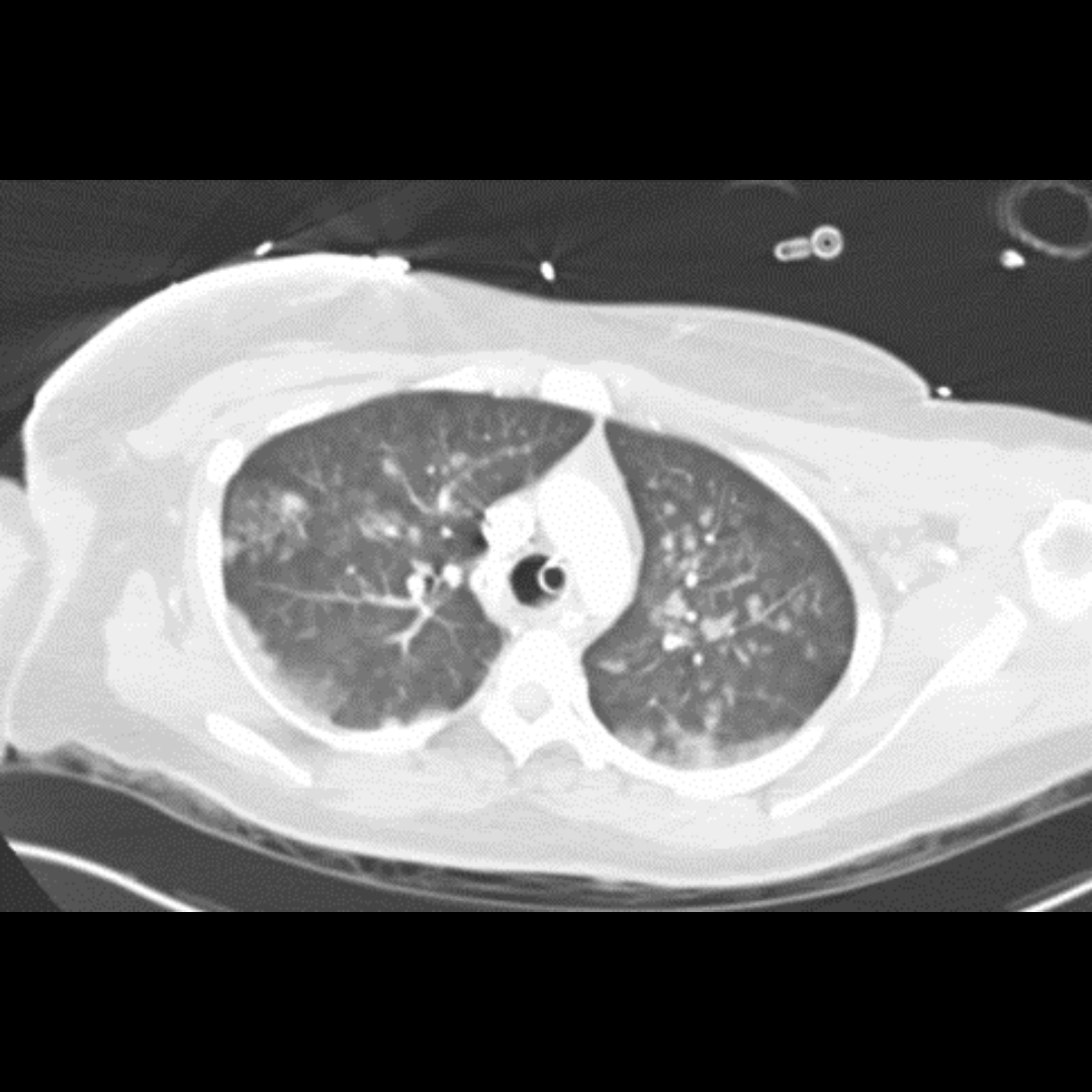dAIgnositX's tweet photo. A person pulled out of the water, unresponsive, was rushed into the hospital for brain and chest CTs.

What do you spot?

Subdural haematoma, subarachnoid haemorrhage, hypoxic cerebral injury / non-cardiogenic pulmonary oedema, or something else?

👉Drop your answers in comments https://t.co/T4wYW48iaO