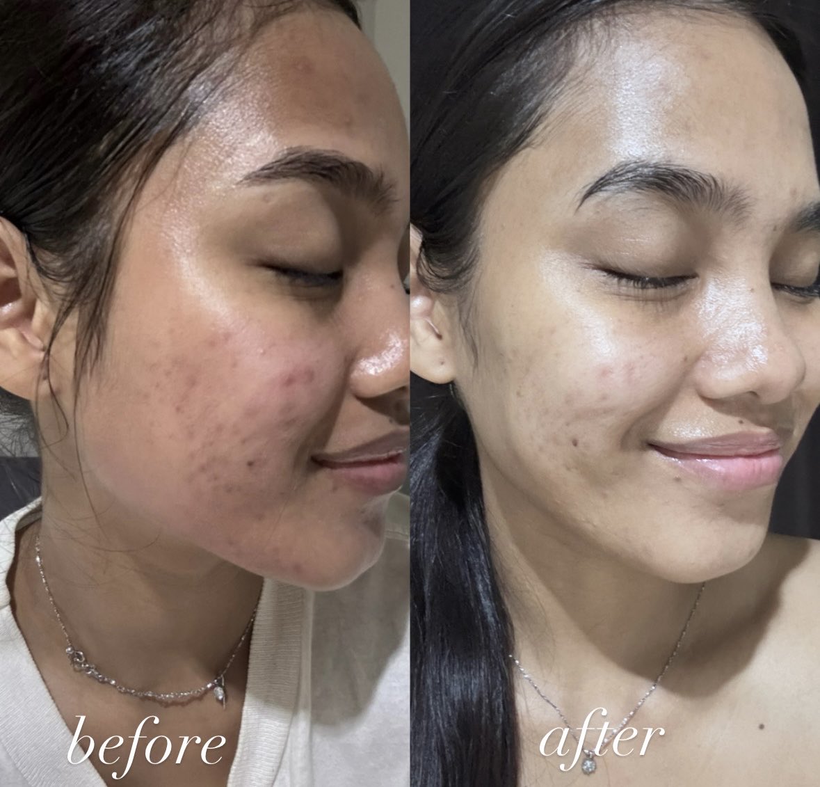 anysnii's tweet photo. ACNE PRONE GIRLIES, I THINK I FOUND MY NEW GO-TO TREATMENT 😭🫶🏻 https://t.co/lTJYJ1MqwB