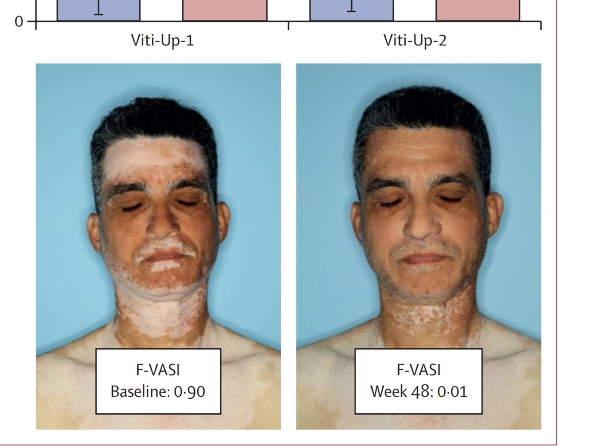 moy_qmac's tweet photo. Upadacitnib (un inhibidor de JAK) de 15 mg al dia (1 tableta) se perfila para ser el primer tratamiento oral/sistémico para vitiligo, que bello.

El capitalismo, como siempre, imparable. https://t.co/PWGMh1w0CU