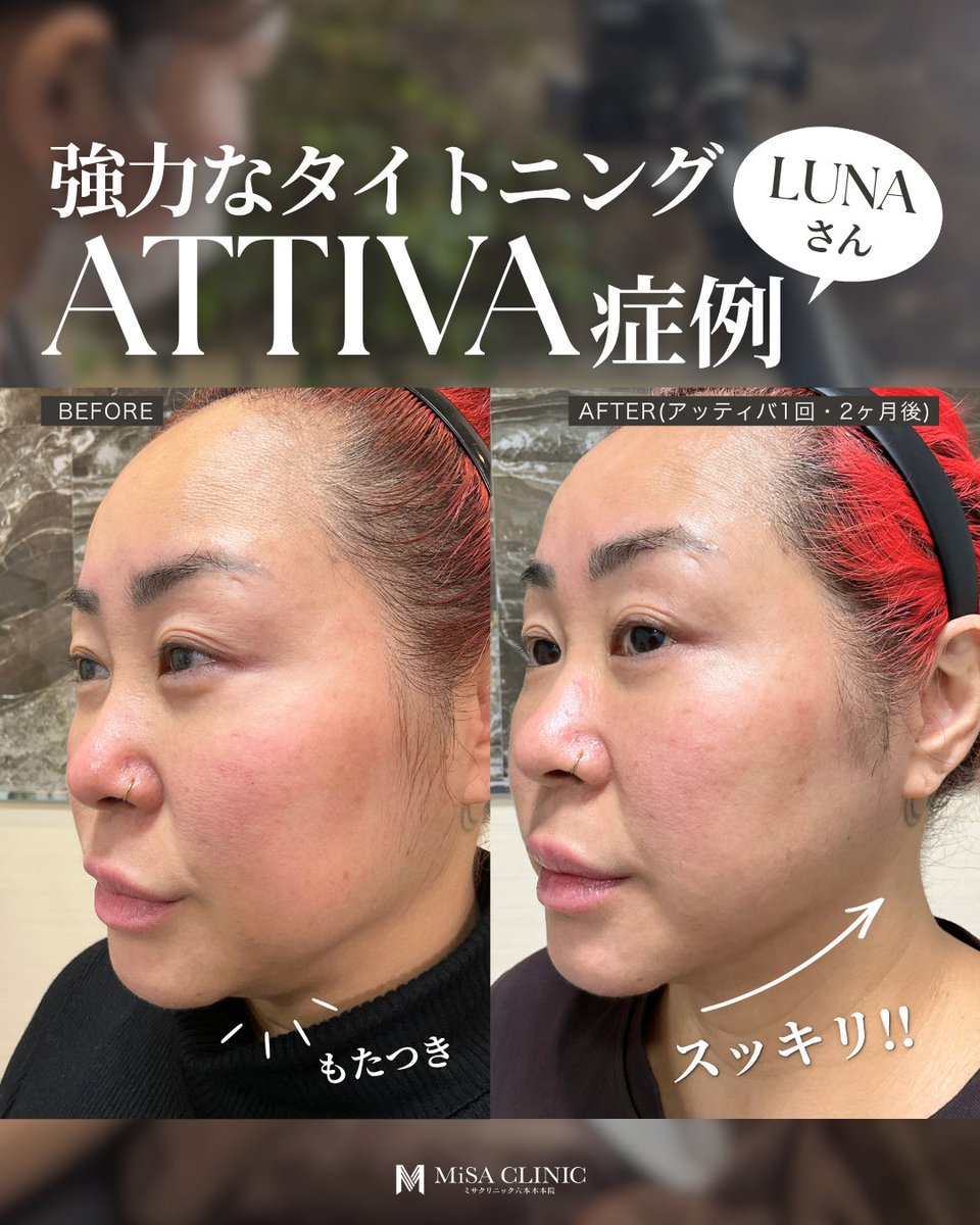 MiSA_Clinic's tweet photo. ✨LUNAさん ATTIVA症例✨
今回は
✔︎ マリオネット〜フェイスライン
✔︎ 右上まぶた
の2部位を施術❣️
施術から2ヶ月後
フェイスラインのもたつきがスッキリし、
よりシャープな印象に✨
上まぶたも引き締まり目元の印象アップ⤴️
#MiSAClinic六本木本院
#ATTIVA
#アッティバ
#切らないたるみ治療 https://t.co/7QQO53FwHb