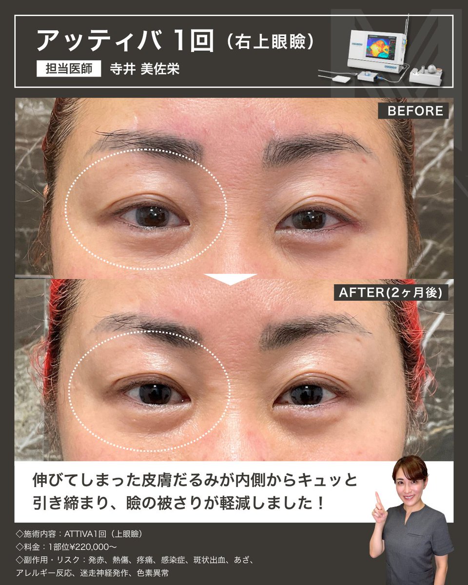 MiSA_Clinic's tweet photo. ✨LUNAさん ATTIVA症例✨
今回は
✔︎ マリオネット〜フェイスライン
✔︎ 右上まぶた
の2部位を施術❣️
施術から2ヶ月後
フェイスラインのもたつきがスッキリし、
よりシャープな印象に✨
上まぶたも引き締まり目元の印象アップ⤴️
#MiSAClinic六本木本院
#ATTIVA
#アッティバ
#切らないたるみ治療 https://t.co/7QQO53FwHb