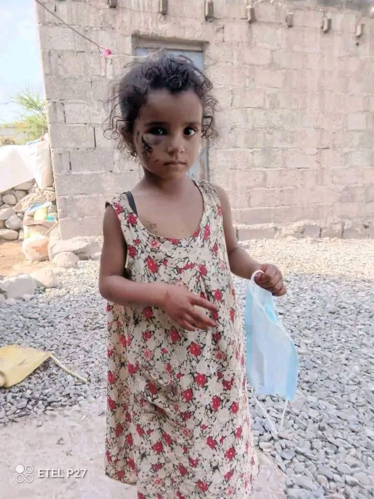 WafaAlwaleedi's tweet photo. خديجة  طارق، طفلة من تعز، إنتقلت إلى رحمة الله اليوم بعد ان كان قد عضّـ.ـها كلب مسعـ.ـور في الوجه، منذ أسبوعين. انتشرت الكلاب بشكل رهيب في تعز 
الي متي هذا الوضع المؤلم في اليمن  وهذي المأساه متي تنتهي https://t.co/SGi5padck8