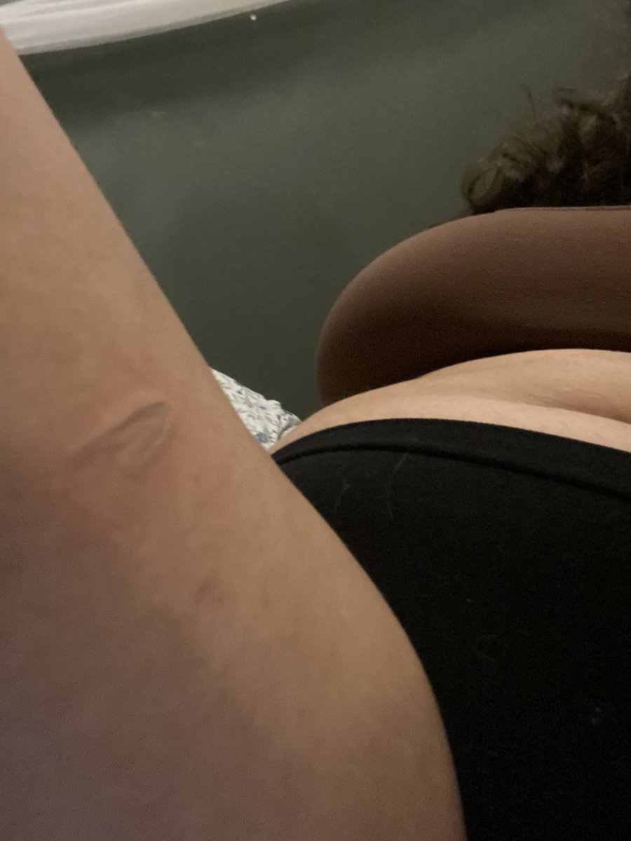 fawnseek's tweet photo. Didn’t want to wait for them to cool down, close ups of new “burns”. 
Plus one on my inner thigh.. per request <33 🐾🍮
Real 🏷️: #puppygirl #hurtme #shedtwt 
(For twt: #sfxmakeup)
🐾 Had to bite my poor plushie as a gag LOL https://t.co/AwBP496K24