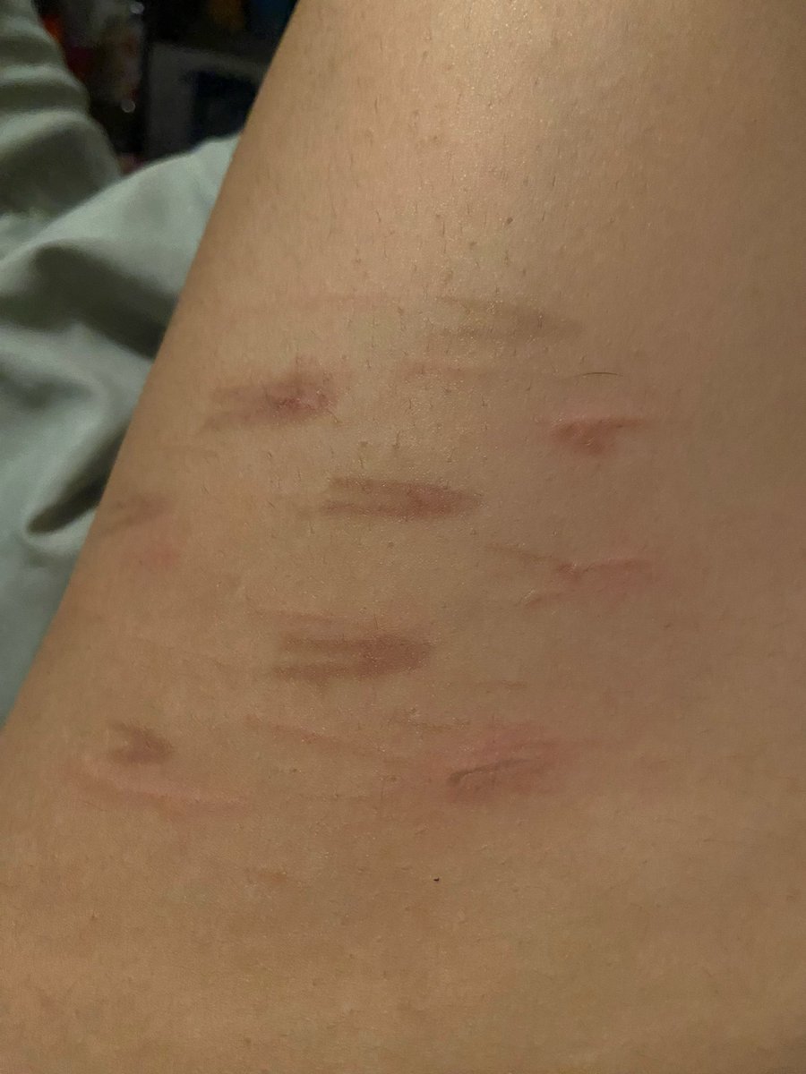 fawnseek's tweet photo. Didn’t want to wait for them to cool down, close ups of new “burns”. 
Plus one on my inner thigh.. per request <33 🐾🍮
Real 🏷️: #puppygirl #hurtme #shedtwt 
(For twt: #sfxmakeup)
🐾 Had to bite my poor plushie as a gag LOL https://t.co/AwBP496K24
