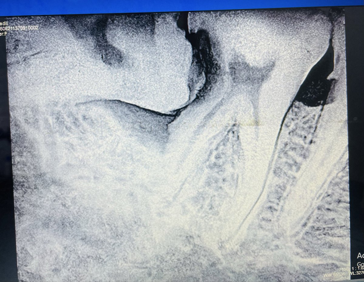DentalSurgnxis's tweet photo. What is Your Diagnosis???
What will be the treatment plan???
#dentist
#dentalhealth https://t.co/f9TPOqb9Fa