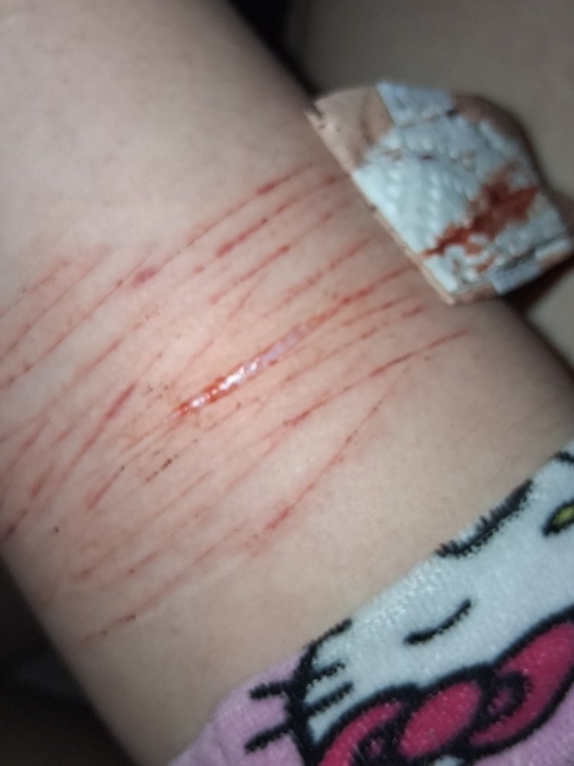 angelwingssbfy's tweet photo. @Yeklvz Oki can you tell me what one was mine cause the nurse and doctor said it was Hupodermis but I still think it was styro https://t.co/EefpgjB8yw
