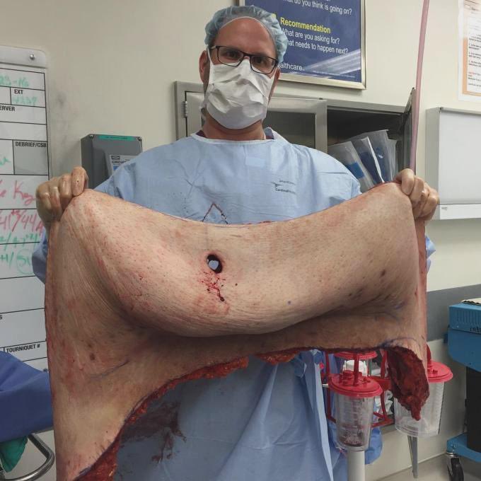 anatomie_x's tweet photo. Rund 10 kg überschüssige Haut und Fett wurden nach massivem Gewichtsverlust entfernt. Solche Hautüberschüsse können Bewegung, Hautpflege und Alltag stark beeinträchtigen. Mehr im Kommentar ⬇️ https://t.co/E9GJpryLtz