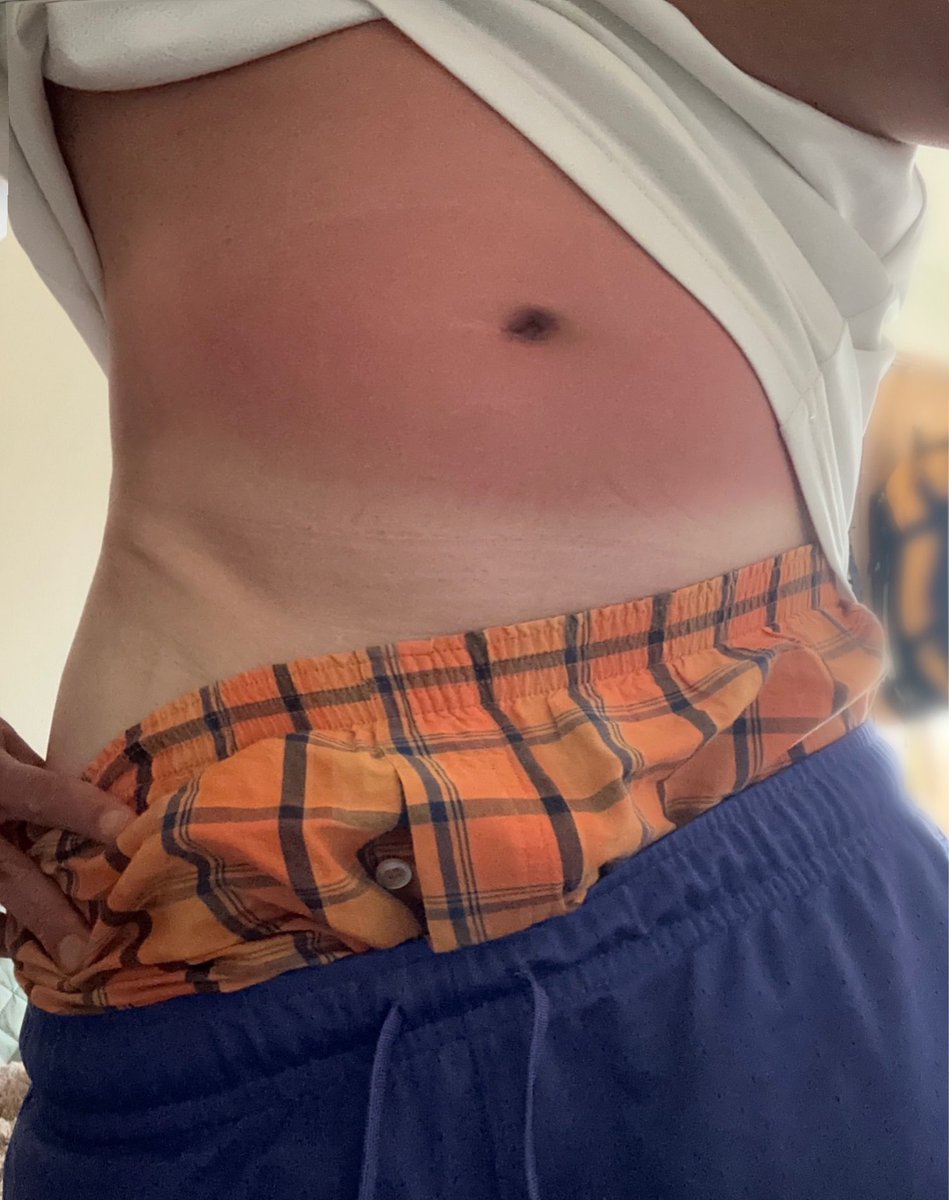 pote_ringu's tweet photo. ちょい遅めのお盆休み…🏖️
その⑤

海行くと日焼けでお腹だけ真っ赤になってしまう😵‍💫✨
ぴえん🥺ww笑 https://t.co/idicaJJljV