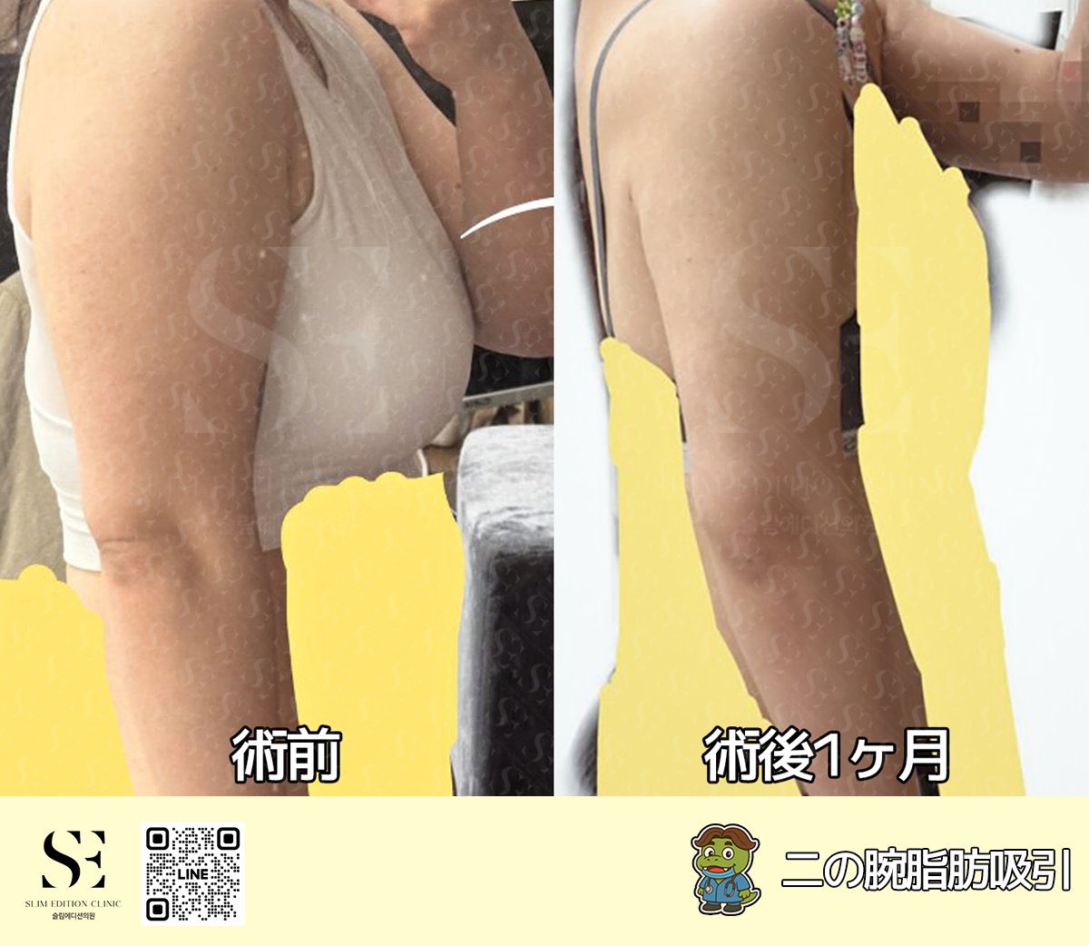 slimededition's tweet photo. スリムエディションの脂肪吸引 Before＆After✨
手術部位：二の腕360＋副乳＋脇＋肩甲

💛二の腕セット料金：250万w💛

お問い合わせ💌 https://t.co/R5PcHqEQJy

二の腕脂肪吸引から約1ヶ月後の経過をご紹介📸

気になっていたボリュームがすっきりし、
肩から二の腕にかけてのラインもよりシャープな印象に✨

横から見たときの厚みも抑えられ、
腕全体がすらっとコンパクトに見えるシルエットへ☺️💕

まだダウンタイム中なので、
これからさらに腫れが落ち着き、ラインが馴染んでいくのが楽しみです🫶