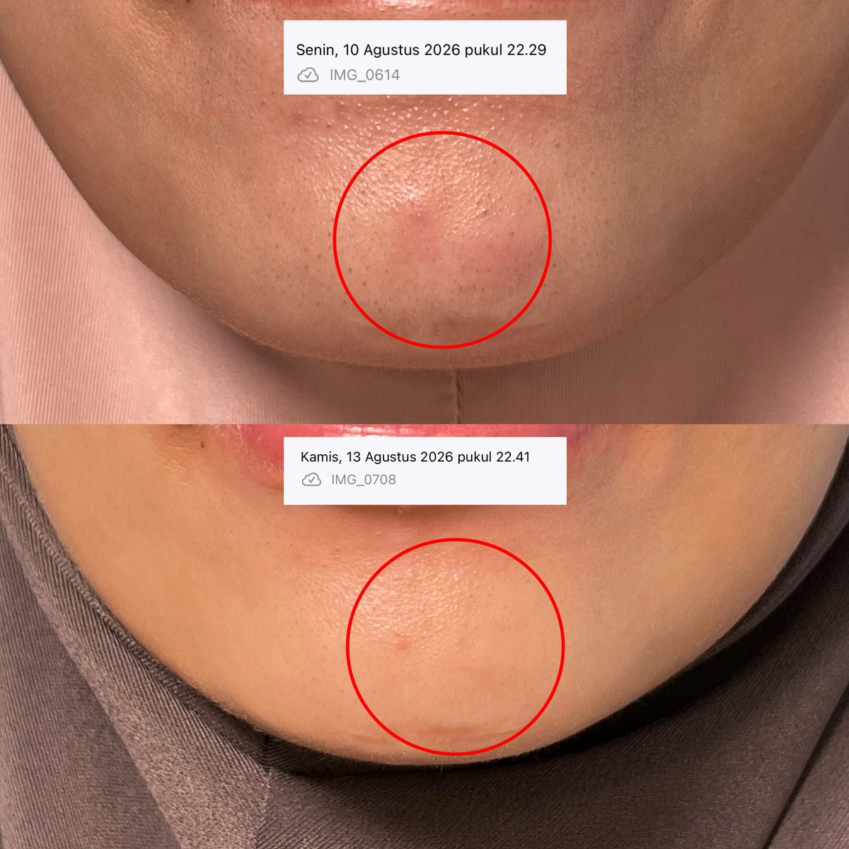 irwanyns's tweet photo. Gak expect bgt jerawat mendemku bisa kempes dalam waktu 3 harian, cuma pake acne serum cuyy 😭👊🏻 https://t.co/g9YQ6sxSGR