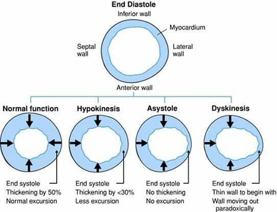 HiraaliCardio's tweet photo. ⇒ Normal segment thickens by about 50% during systole moves inward well that's healthy muscle doing its job

⇒ Hypokinesis means the wall still moves
just weaker than it should thickening drops below 30%
motion looks sluggish not absent

⇒ Then there's the segment that doesn't move at all
no thickening no inward motion this is dead or badly ischemic tissue different problem than sluggish muscle

⇒ Dyskinesis is the one that surprises people early on
wall doesn't just fail to move inward it moves outward during systole it bulges instead of contracts
