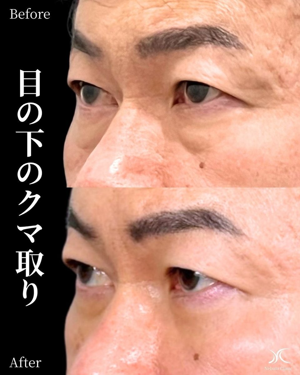 aichi_nebula's tweet photo. 【男性のクマ取り】
目の下の膨らみを取ることで、見た目年齢が
グッと若がえります😄

ただし取る量の適性を見誤ると、
凹みすぎににもなるので、しっかりと技術のある医師にお願いしましょう！

目周りの整形のご相談は愛��春日井美容外科ネビュラクリニックへ
#クマ取り #愛知 #ネビュラクリニック https://t.co/MMbEOrlnFc