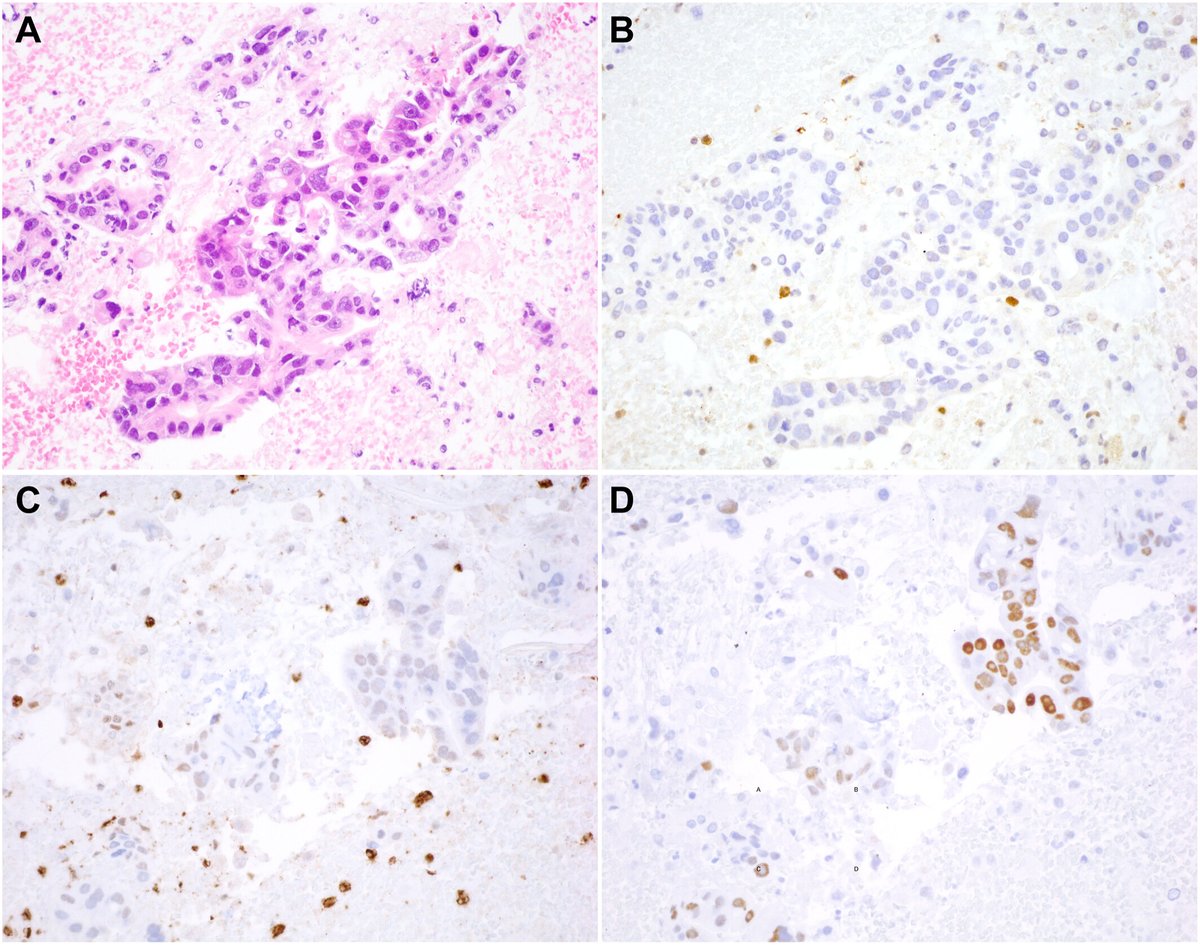 CancerCytopath's tweet photo. 💥MTAP IHC can support a diagnosis of pancreatic ductal adenocarcinoma in small biopsy samples

https://t.co/97fyv8U7YN

@SanhongY @JLHornick #CytoPath #IHCPath https://t.co/uRT2ZQRjZV