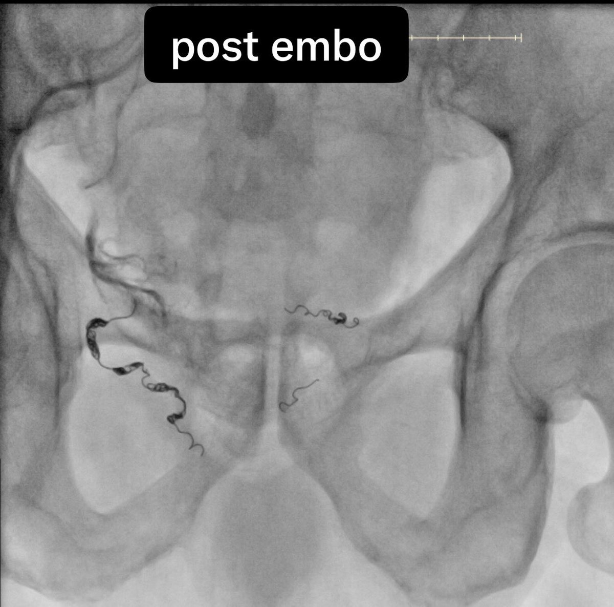 PAE post embolization