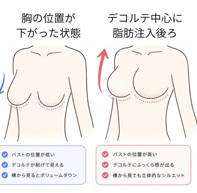 dr_nakanishi_y's tweet photo. デコルテ（胸の上部）に脂肪を注入すると、ハリが出て見えます。

「胸にハリがない」という方は、実は胸の位置が低い方が多い。胸の位置を上げるだけで、ハリのある胸に見えるんです。

そして胸の位置が低い方は、骨格ウェーブの方が多い傾向があります。

ハリのなさは、「胸の位置」と「骨格タイプ」が関係しています。