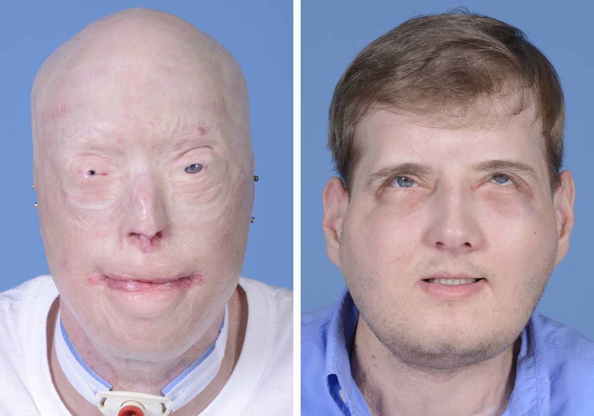 prsjournal's tweet photo. 🧬 What’s next for vascularized composite allotransplantation?

Explore the new PRS Global Open Mini-Series from NYU Langone Health and the advances shaping VCA.
🔗 Read the mini-series: https://t.co/gcHklXEfFG

#PRSGlobalOpen #VCA https://t.co/xDa1ro9ebP