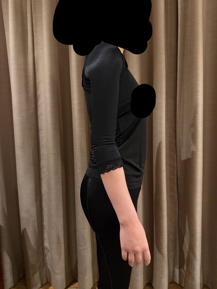 nyanyid9's tweet photo. レアートさんで太もも、二の腕脂肪吸引してきました。
限界までとってもらえたみたいです！
ほんとに対応が神がかかってるので自分的には本当に助かりました。
不安で沢山きいてもすぐ返信くるし私に合ってました！
ちなみに全部合わせて3000ccとってもらったみたいです
#レアート #脂肪吸引 #ソ院長 https://t.co/PM95ipuCDM
