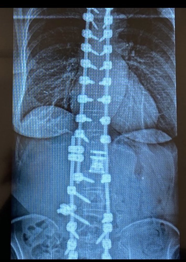 vivansdotter's tweet photo. @instablog9ja I was also strong when I was younger, now my back looks like this after 10 surgeries. I hope she stops carrying heavy weight. https://t.co/TfsD7ncUvv