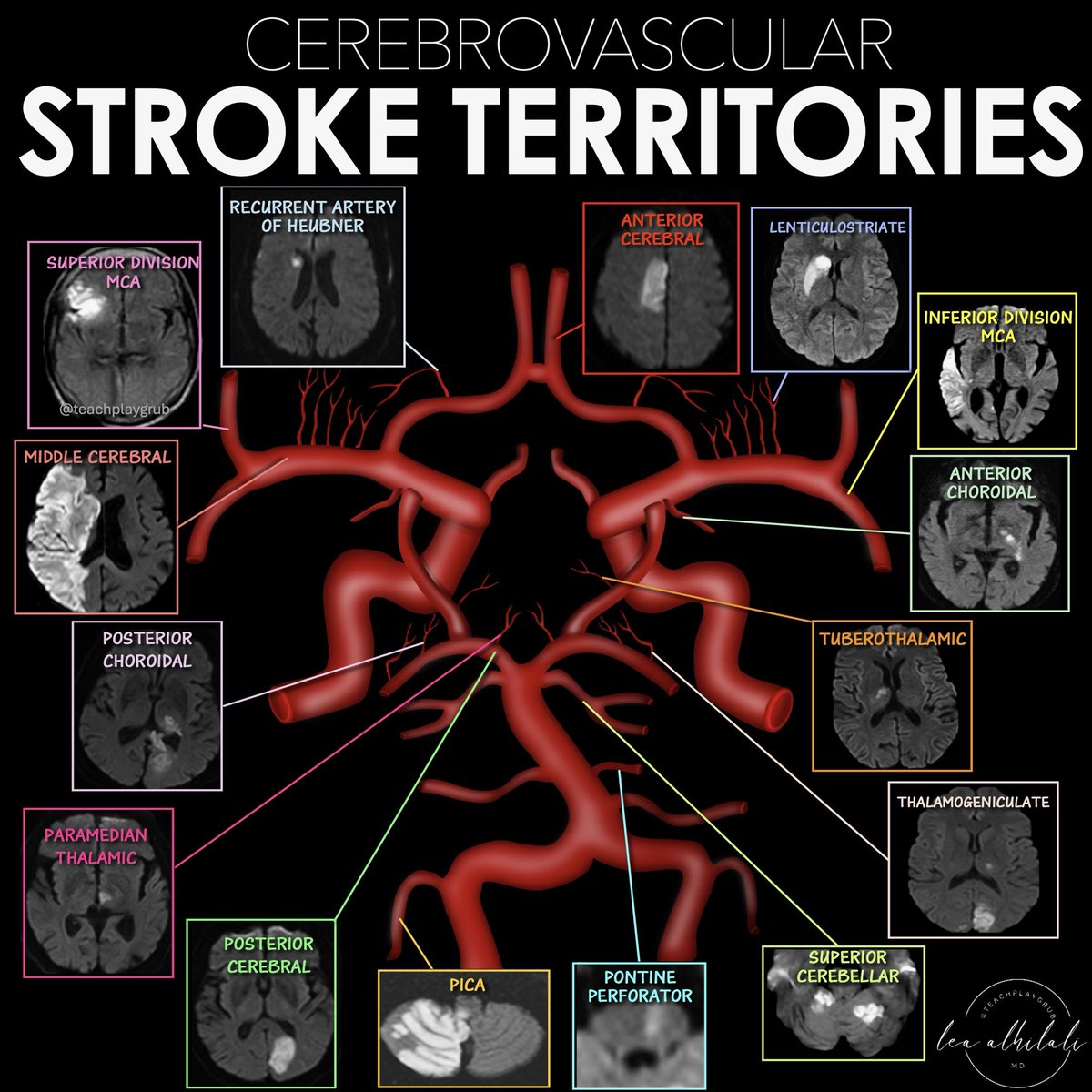 teachplaygrub's tweet photo. Anyone can see the bright spot of diffusion imaging!

What sets you apart is your ability to tell them where it is—what vascular territory

Here are the vascular territories you need to know:

* Posterior Inferior Cerebellar Artery (PICA)
Soft under surface of the cerebellum

* Superior Cerebellar Artery (SCA)
The SCA territory is the top of the cerebellum (SCA is the SCAlp of the cerebellum)

* Basilar perforators
Make a line in the pons like a penetrating injury. So perforator infarcts look like perforating injuries

* Anterior Choroidal artery
This supplies the posterior limb of the internal capsule & corticospinal tract. Remember COR-roidal is COR-ticospinal

* Lenticulostriate arteries
Infarct territory looks like a tadpole

* Heubner's artery: infarct is the caudate head.
Remember "who called" which sounds like "heu caud" so heubner takes out the caudate

* Anterior cerebral artery (ACA)
Medial, anterior surface of the cerebral hemispheres

* Middle cerebral artery (MCA)
Lateral surface of the cerebral hemispheres

* Posterior cerebral artery (PCA)
Medial, posterior surface of the cerebral hemispheres

Hopefully now when it comes to the vascular territories, you will always be right when it's bright!!