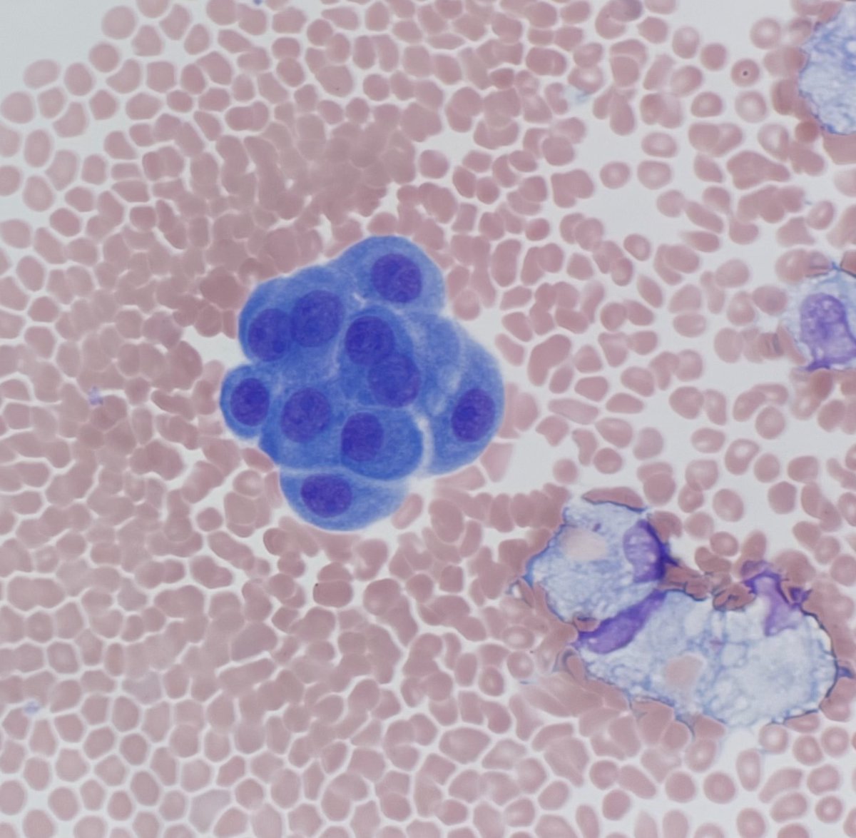 PathologyKate's tweet photo. What causes the circumferential lucent spaces, sometimes called “windows”, between these cells? #Boardfodder https://t.co/LoHEaVkJTw