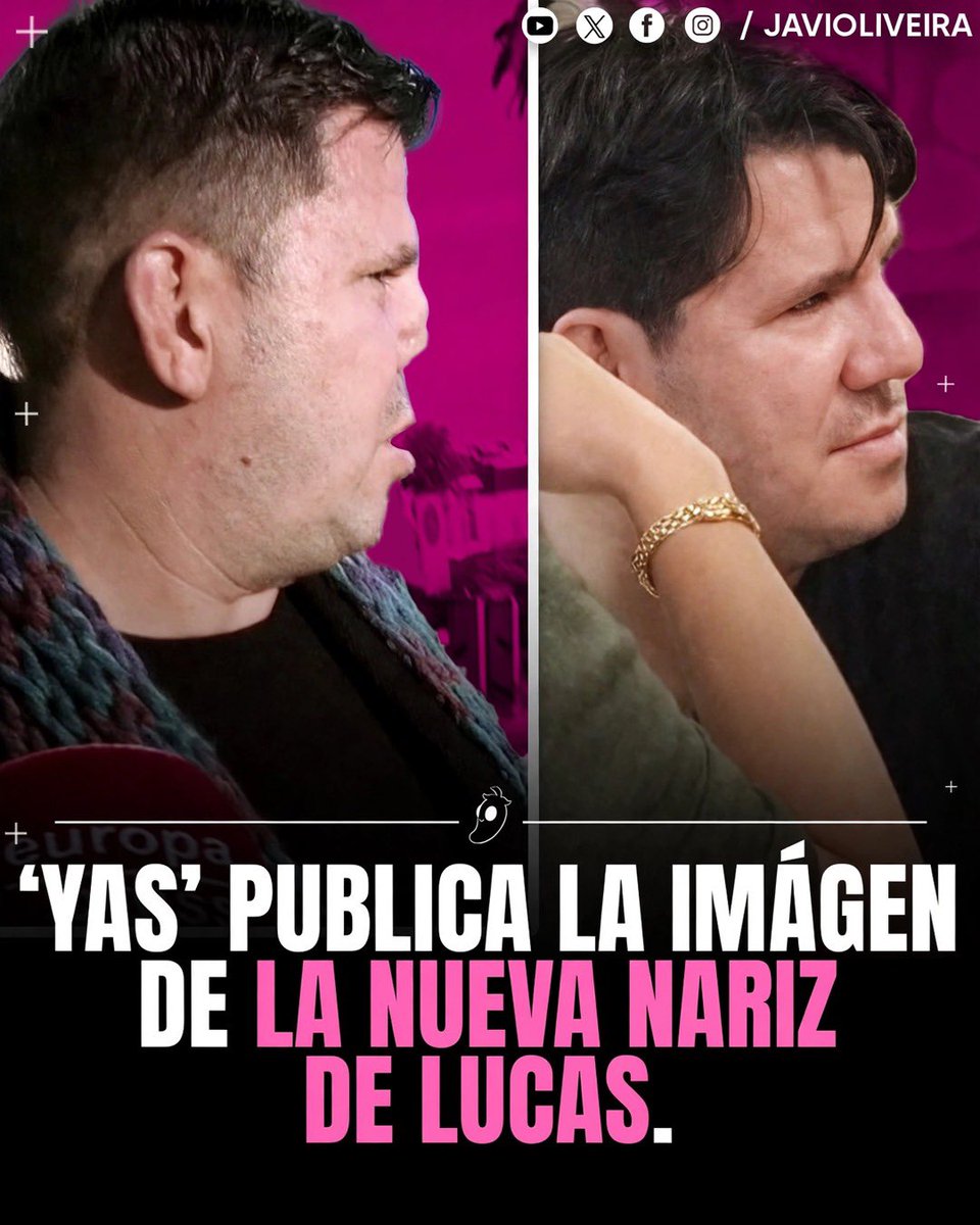 javioliveira's tweet photo. La imagen de la nueva nariz de Lucas, de Andy y Lucas: así es el rostro renovado del cantante tras su operación. https://t.co/Ey5arkLiyJ