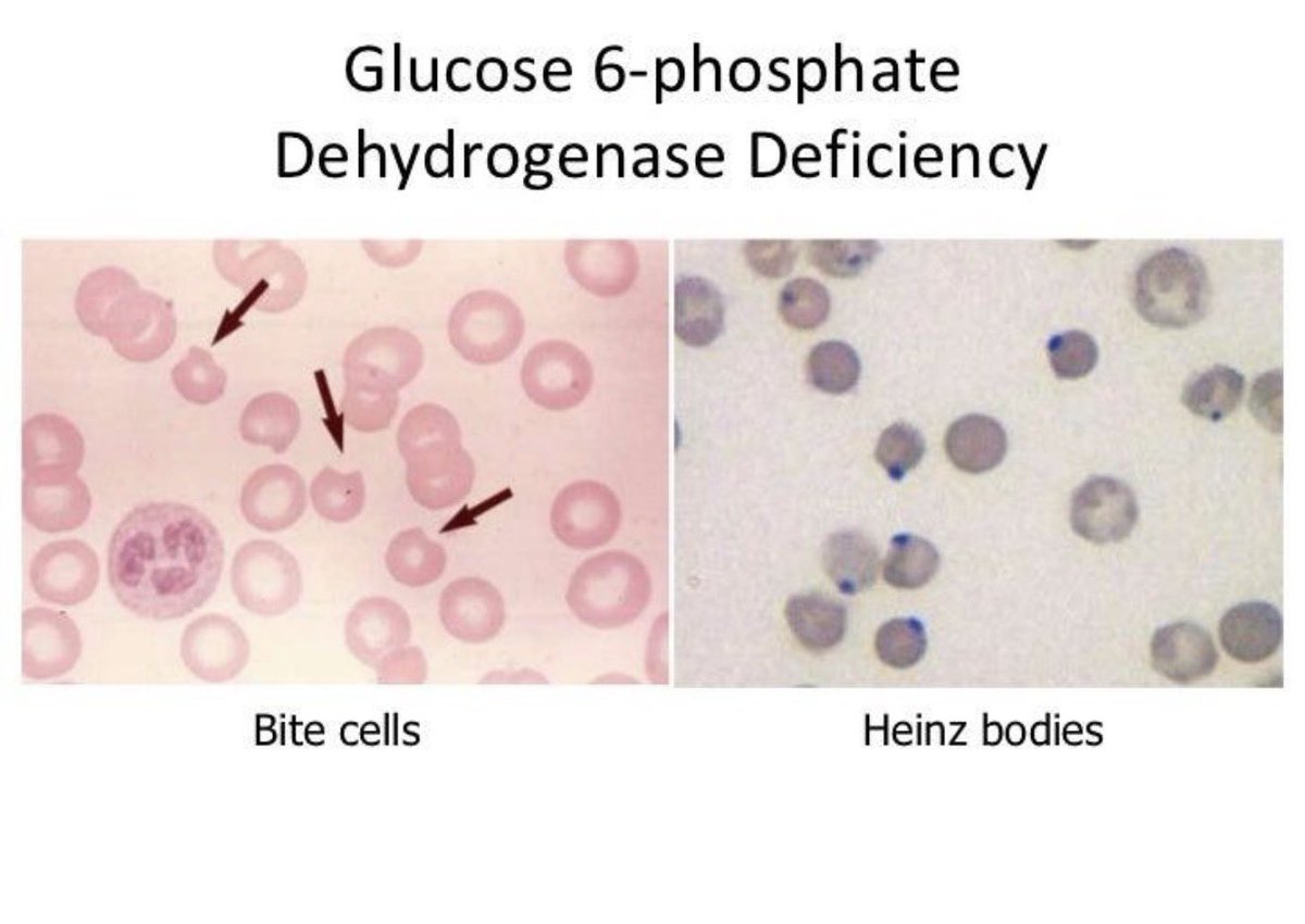 laboratorykh's tweet photo. معلومة مهمة |🔬

لماذا لا يُفضّل فحص G6PD أثناء نوبة الـHemolysis؟

أثناء النوبة تتكسر كريات الدم الحمراء القديمة، فيحفّز نخاع العظم إنتاج Reticulocytes لتعويض الفقد

🔬 والـReticulocytes تحتوي على نشاط G6PD أعلى من كريات الدم الناضجة

لذلك نرى نتيجة طبيعية كاذبة رغم النقص https://t.co/N88197PSGb
