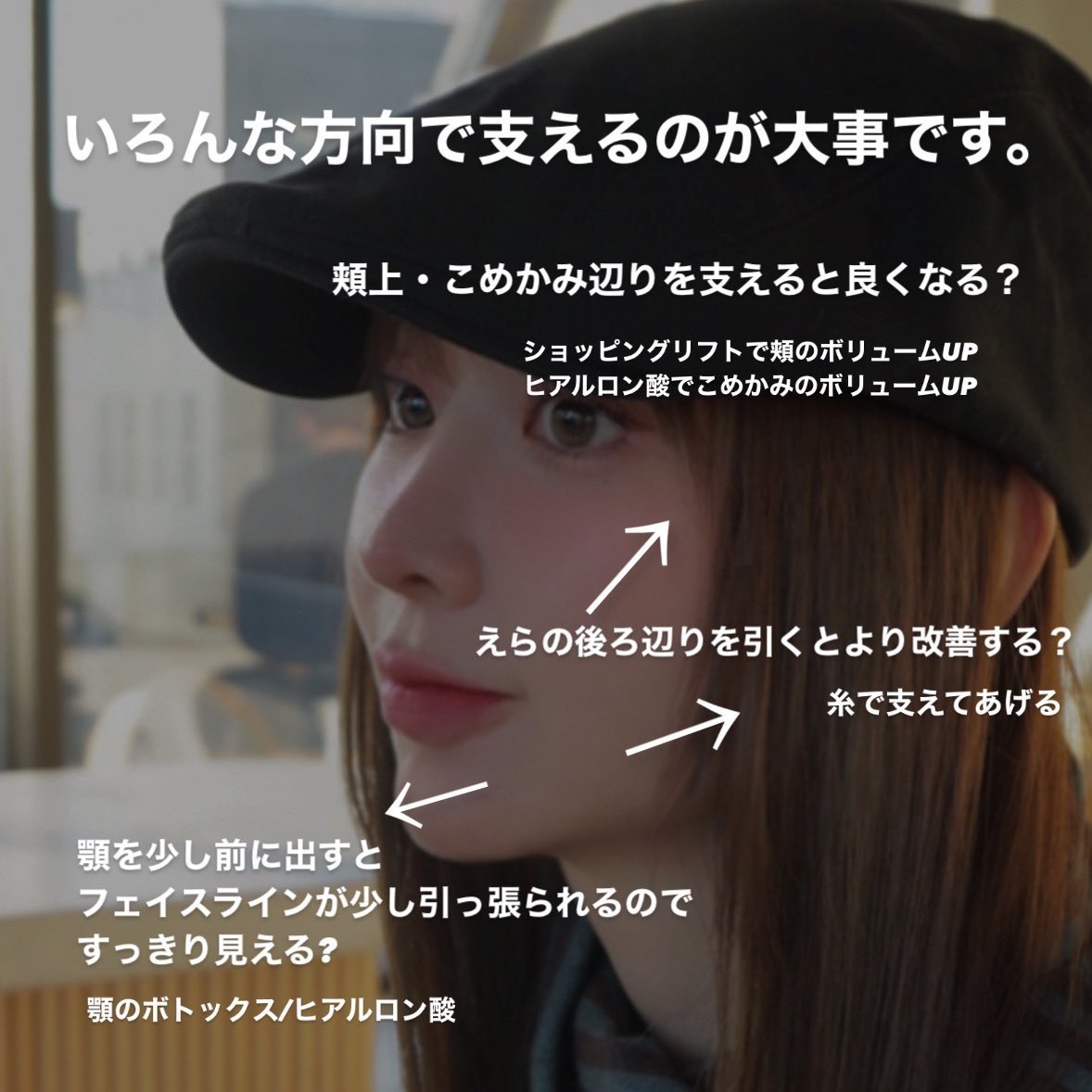 chika_biyouhihu's tweet photo. 糸を何回入れても口横ぽにょやほうれい線が改善しない時、、、

たるみじゃなくて、骨が小さいからだと説明され、鼻横（鼻翼基部）と口角下にヒアルロン酸入れた時の帰り道の私（3枚目）

4枚目完成系 https://t.co/tBpzUKM7re