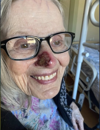 skymeds_store's tweet photo. I just had to share this. 🙌
My mom had this nasty spot on her nose. Skin cancer (SBCC). It kept getting worse.

They gave her Aldara cream – $120 out of our pocket. It barely helped.

I called my sister – she had Ivermectin cream prescribed for my nephew. She sent it to me.

Day 1:
I put it on her nose myself. The nursing home staff looked at me sideways. I didn't care.

Day 2:
I went back the next morning and couldn't believe my eyes.

The redness had already calmed down. The crusty spot was shrinking. It was like night and day.

I took a picture. Compared it to the day before. I almost cried.

Day 5:
Completely gone.

Just like that. A $250 tube of Ivermectin cream did what the $650 prescription couldn't.

Her nose is smooth. Clear. Like nothing was ever there.

Mom's doctor?
He was impressed. Couldn't believe it. He actually ordered a tube for the nurses to use if any other lesions pop up.

Ivermectin isn't just for parasites.
It's for skin cancer. For rosacea. For stubborn fungal infections. For all kinds of things the system won't tell you about.

Liquid. Paste. Pills. They all have their place.

I'm so grateful my mom is close by.
I can go in, monitor her, and be her advocate.

Some doctors don't recognize Ivermectin for skin cancer. But I knew it was worth a shot.

And here we are.

Praise The Lord. 🙏