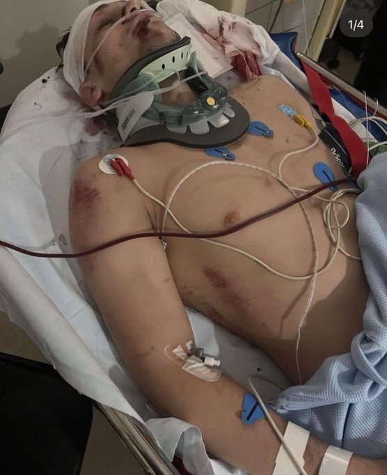 DovySimuMMA's tweet photo. 😲Liam McCracken who will compete on this weeks DWCS was hit by a bus and dragged 60ft less than 3 years ago 

He was running with his headphones on and was blindsided by a bus 

His body was found under the bus

His injuries were insane: 4 fractures to his spine, broken pelvis, broken ribs, broken legs, broken nose, neck injuries, torn MCL/meniscus, and severe injuries to his head, ear, lip and legs