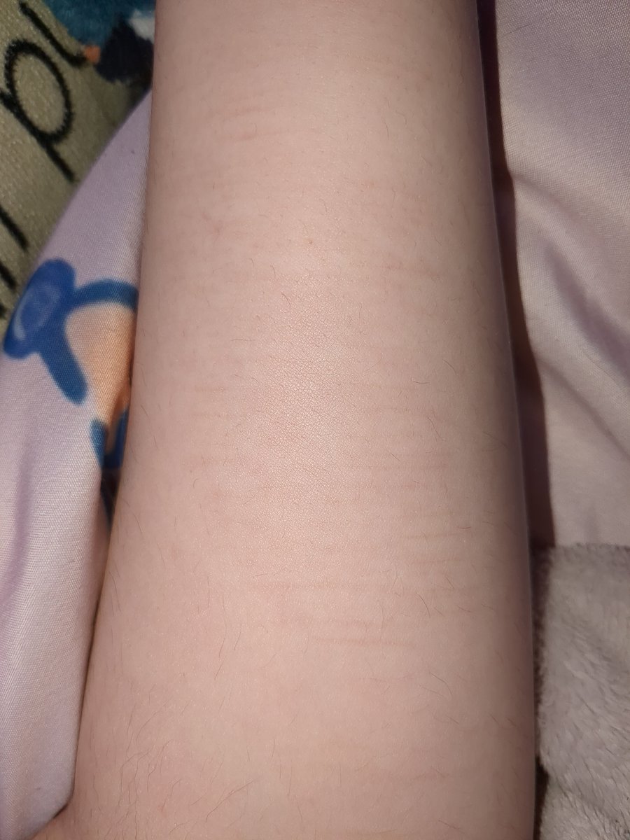AzureG0r3's tweet photo. Bro can TikTok stop larping SH on their wrists? 💔
here is an example of my scars that are very light since I dont SH on my wrists. (Thigh SHer)
#ouchietwt #shedtwt #shrtwt #ouchtwt #slittwt https://t.co/2cVaF0md62
