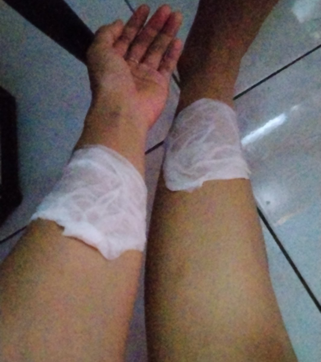 bibwimbapp's tweet photo. Mengawali bulan September dgn luka bakar ringan, kena serok wajan panas yg jatoh dari atas kompor https://t.co/DBK6cid7yZ