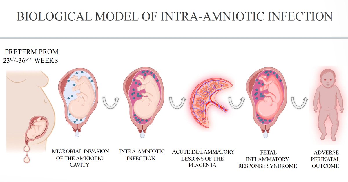 AJOG_thegray's tweet photo. Intra-amniotic Categories of Preterm Prelabor Rupture of Membranes: Gestational Age-Specific Distribution, Amniotic fluid Microbial Profiles, and Neonatal Outcomes https://t.co/mvB8dvZtqB https://t.co/8gDmzLfHwA