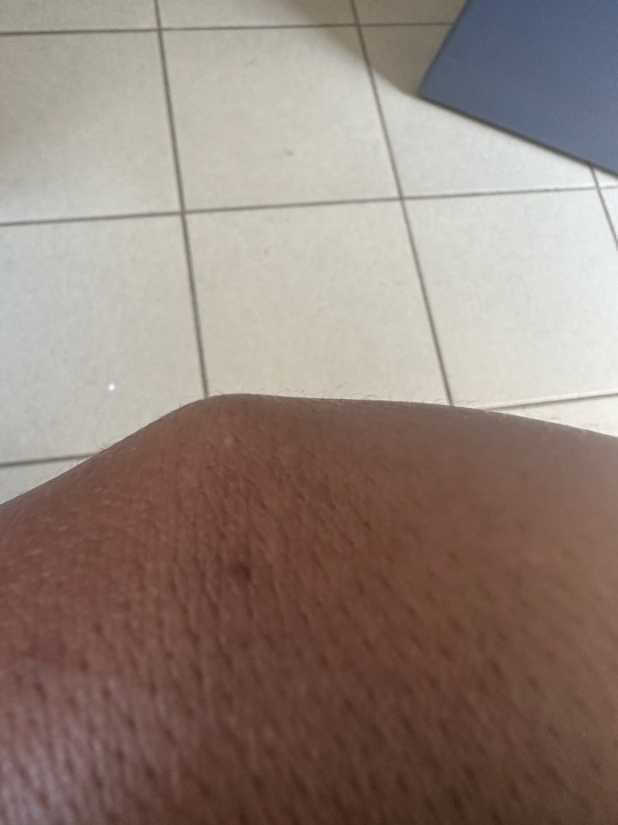 ReadiraMedia's tweet photo. @grok  what is the cause of this bump on the back of hand wrist and what does it need to be normal? https://t.co/1SZQ6zwWmI
