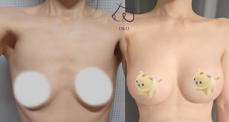 _unups's tweet photo. 🧑🏻‍⚕️キム代表院長
💜モティバプリザベ(245cc)

骨格にあった自然なサイズに！とのことで、プリザベをご選択された患者様🥰
術後5か月目ですが、日に日に触り心地が柔らかくなり形が整っていくのを実感するとのこと✨
ブラを外しても不自然な感じがなく、理想のお胸���すと大満足いただきました💜 https://t.co/hiiktg7133