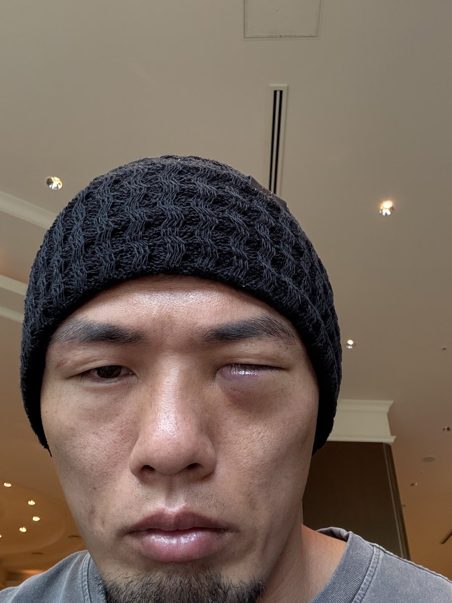 KAWABATA1129's tweet photo. 先日アナウンスされました通り、
9月10日に出場予定だった超RIZIN5を左眼窩内下壁骨折で欠場する事になりました。
対戦予定だった冨澤選手、RIZIN関係者の皆様、応援してくださった方々、本当にすみません。
手術も無事終わり順調に回復してます。
8月中旬に怪我をしてから、自分が欠場の決断がなかなか出来ずにRIZINさんにもご迷惑をかけました。
皆様にも公表するのが遅くなりすみません。
今はもう前向きにできる範囲のトレーニングは再開してます！
必ず皆様に強い姿を見せますので、
今後ともよろしくお願いします！
Don’t mindより